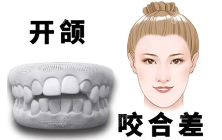 什么是开颌？