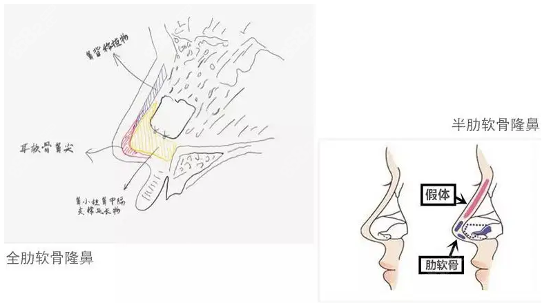 半肋骨鼻和全肋骨鼻的区别