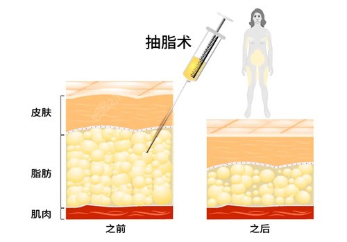 吸脂手术