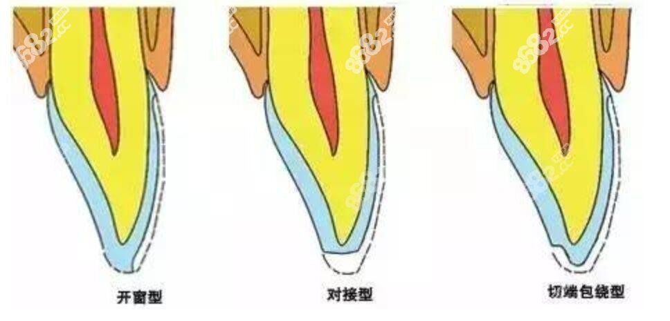 做全瓷牙齿贴面备牙分为几种类型