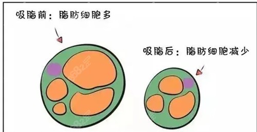 面部吸脂