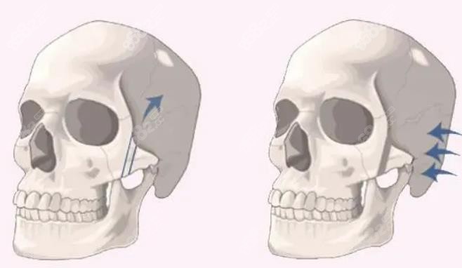 颧骨和颧弓手术示意图