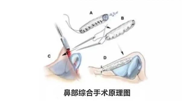 鼻部综合修复搜索原理图