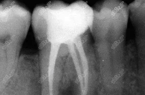 修复后的牙齿牙片示范