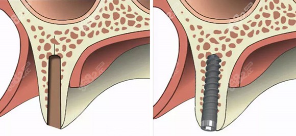 预防种植牙各种缺点的方法