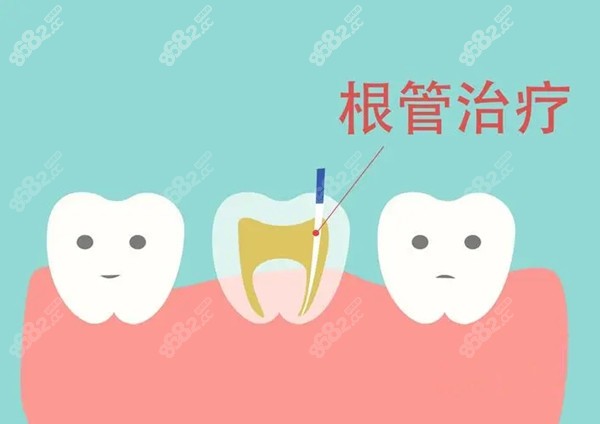 合肥根管治疗多少钱