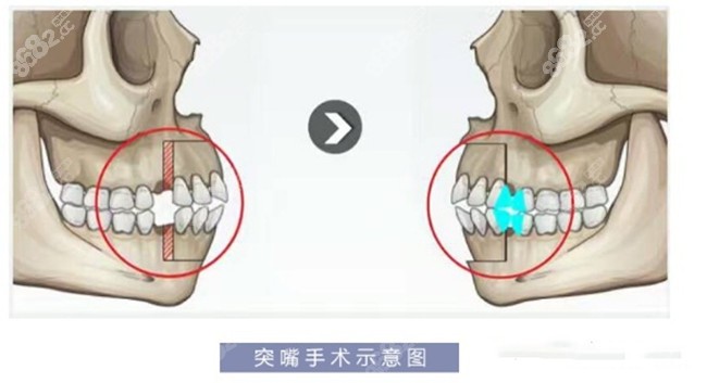 凸嘴手术原理图