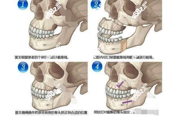 西安能做正颌手术的医院有哪些