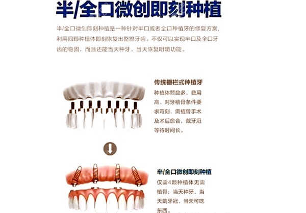 微创即刻种植牙的优势