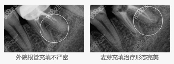 深圳麦芽口腔根管治疗病例展示