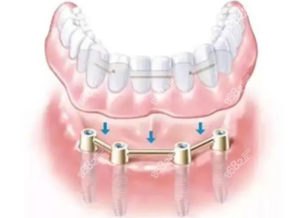 济南口腔医院全口种植牙价格表