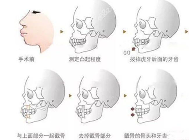 正颌手术的原理8682.cc