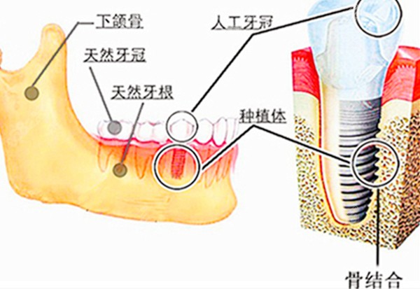 种植牙在牙槽骨内的图
