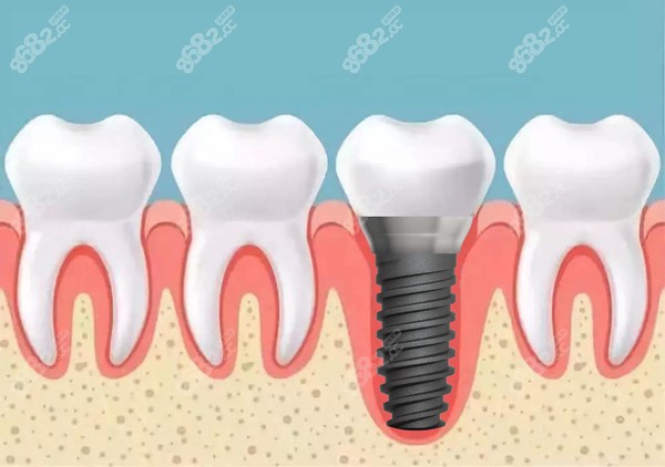 种植牙的致命缺点有哪些