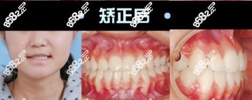 西安美奥冯雪做牙齿矫正