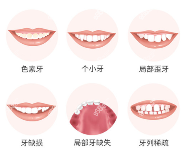 宁波全瓷牙贴面多少钱一颗