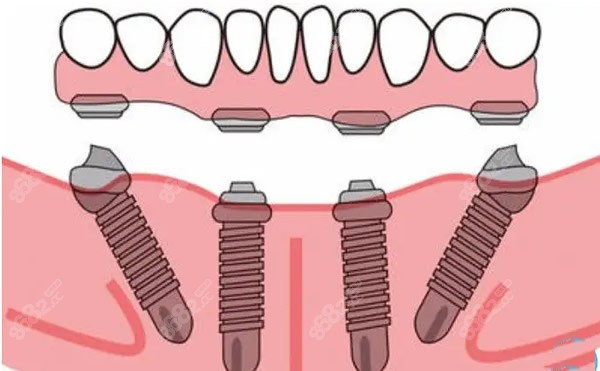 all-on-4半口种植牙优缺点