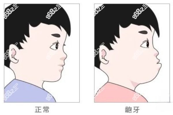 9岁龅牙可以正畸吗