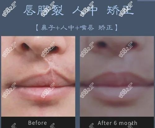 崔宇植大量的唇腭裂修复手术实例