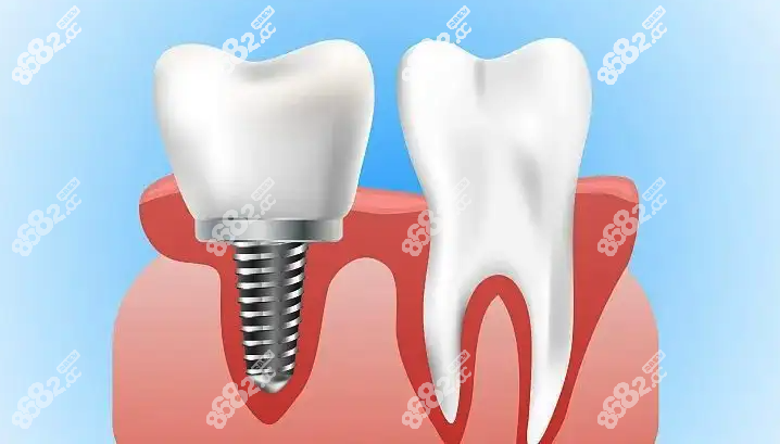 千万不要做种植牙担心什么