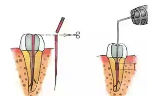 牙齿根管治疗示范图