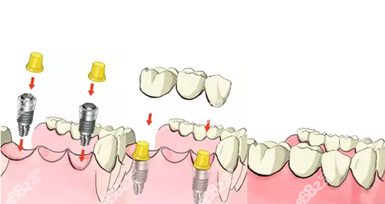 北京中诺和上海鼎植种植牙价格不贵