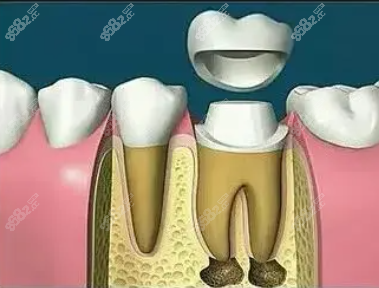 牙冠修复牙