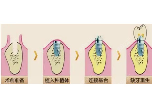 种植牙的流程图