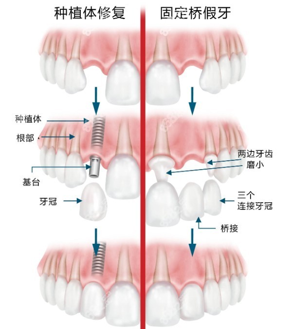 济南口腔医院种植牙价格