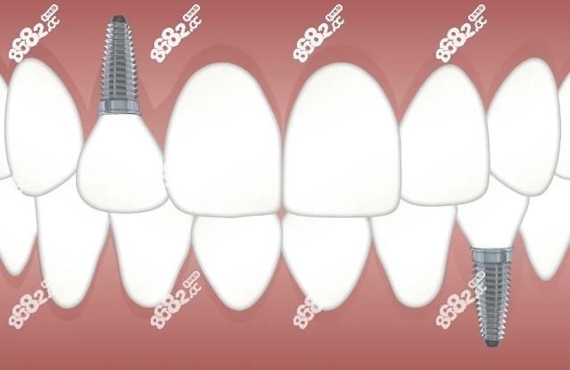 济南种植牙哪家医院好