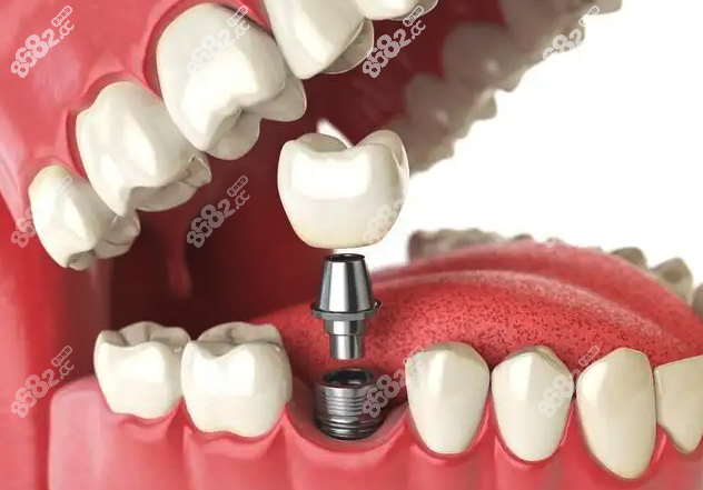 国内种植牙技术成熟