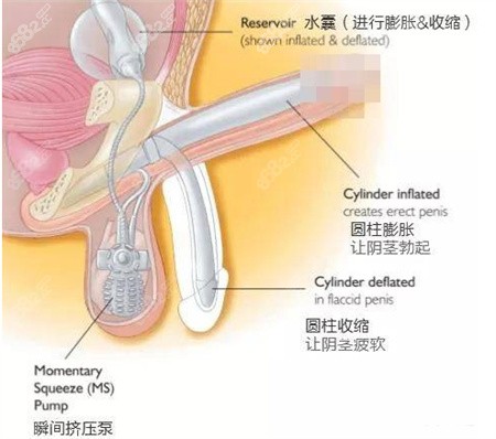 阴茎假体植入手术增粗后，会被发现吗？