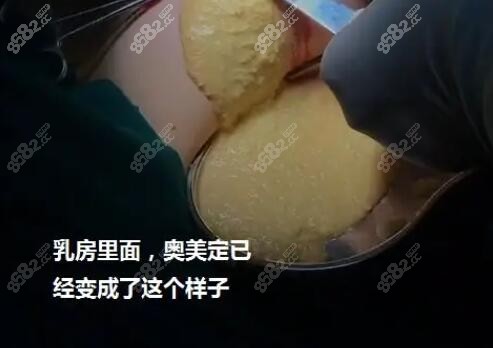 奧美定注射隆胸20年啦有硬塊怎么辦？