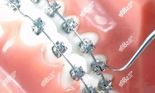 厦门牙齿矫正费用表
