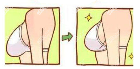 韓國(guó)乳房下垂矯正醫(yī)院哪家好 韓國(guó)乳房下垂矯正醫(yī)院哪家好