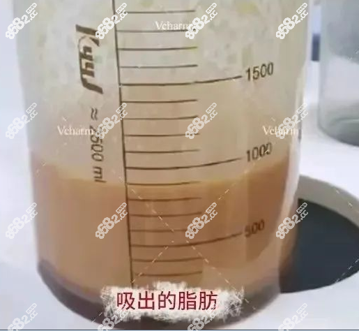 安可忍擅长的5G天使光雕吸脂