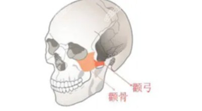 颧骨内推会导致皮肤下垂吗2