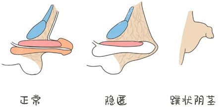 异常的阴茎类型有哪些？