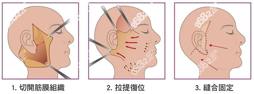韓國(guó)拉皮手術(shù)好的醫(yī)院 韓國(guó)拉皮手術(shù)好的醫(yī)院