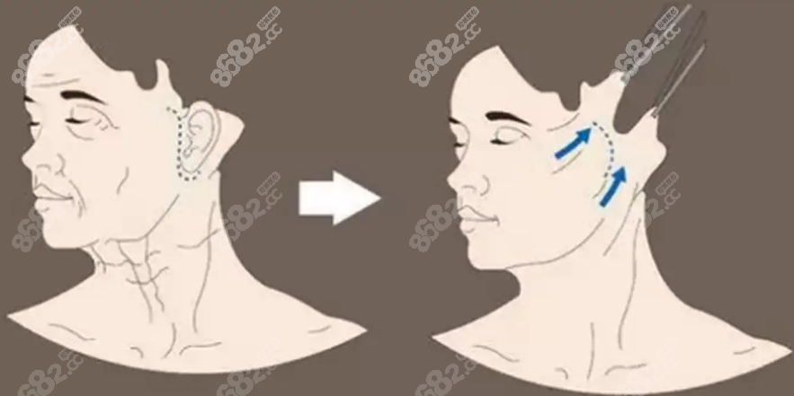 韓國(guó)十大面部除皺醫(yī)院排行榜 韓國(guó)十大面部除皺醫(yī)院排行榜