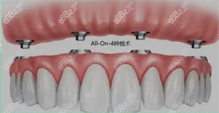 龙泉新华口腔种牙怎么样？