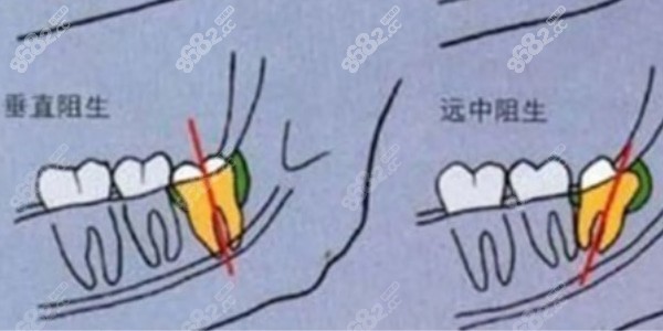 邯郸拔智齿单颗价钱