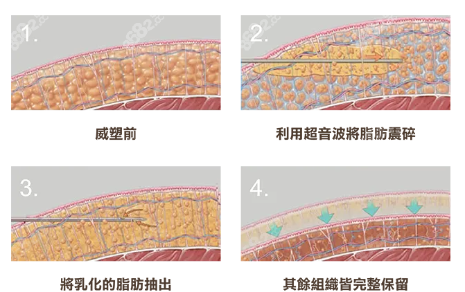 威塑吸脂的方式