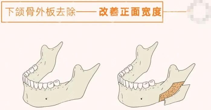 邱立东做下颌角