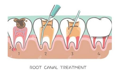 根管治疗