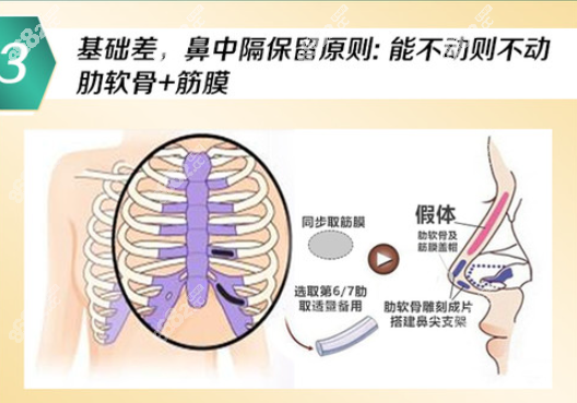 为什么不建议做肋骨鼻手术