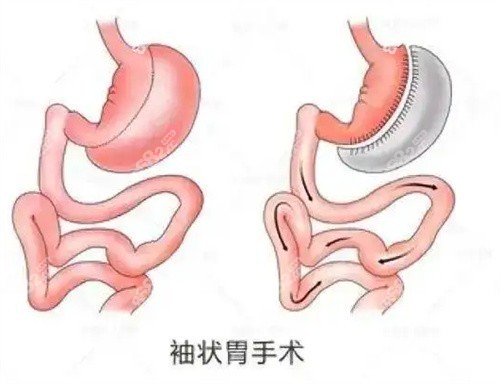 国内袖状胃手术示意图