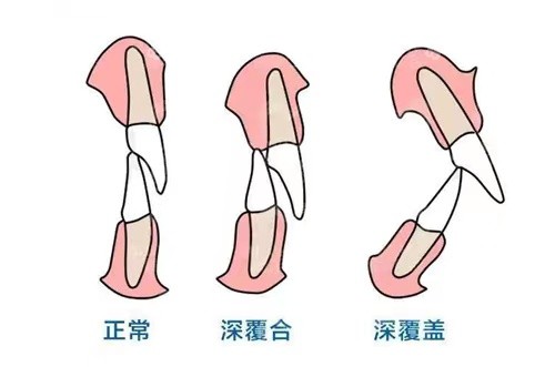 深覆合嘴凸怎么矫正才好呢