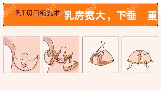 乳房悬吊术怎么做的图片