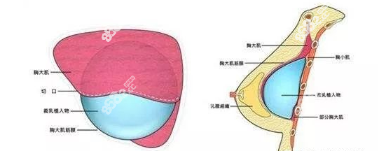 陈成隆胸采用了双平面技术